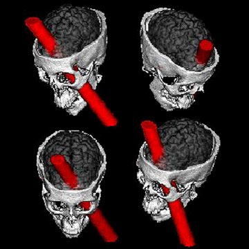 Phineas Gage