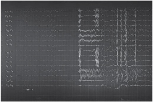 epilepsy EEG