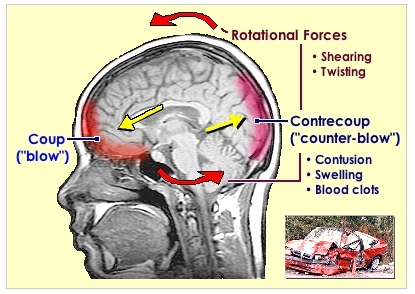 closed head injury