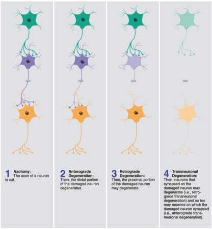 transneuronal degeneration