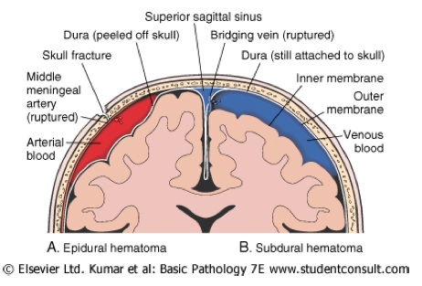 hematoma